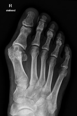 Hallux Valgus